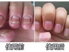 绍兴灰指甲治疗预防灰指甲的有效措施