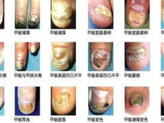 绍兴治疗灰指甲-灰指甲的常见症状有哪些