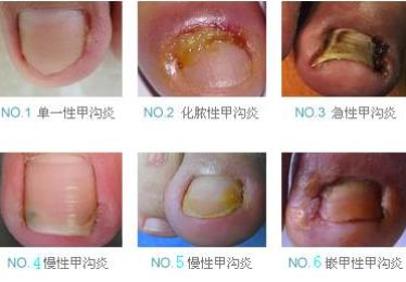 绍兴甲沟炎治疗化脓性甲沟炎应该如何预防？