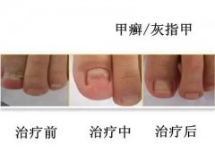 那么灰指甲发病会出现什么症状特征呢